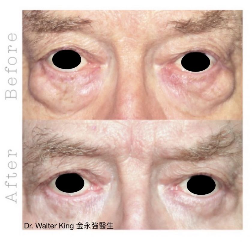 Eyebag Removal Surgery Before & After 2