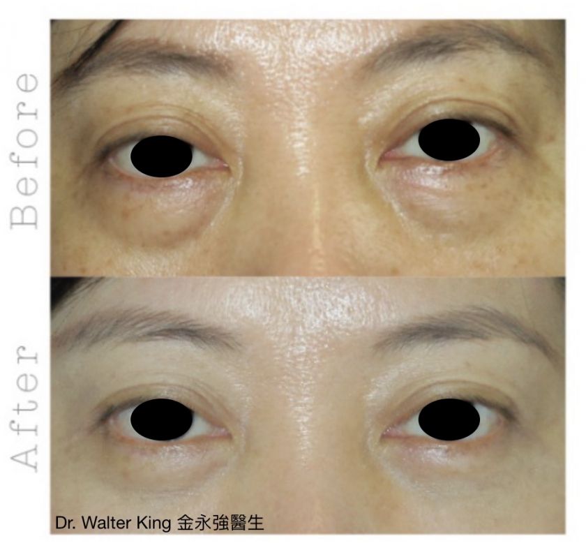 Double eyelid sale surgery hong kong